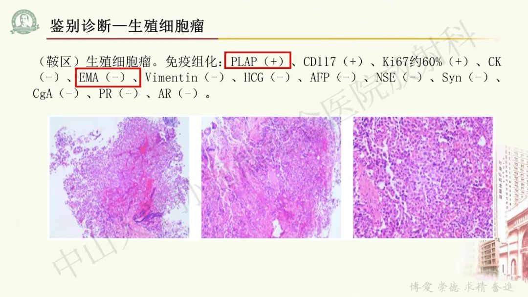 影像PPT - 【病例】毛细胞黏液样星形细胞瘤1例CT及MR影像-28