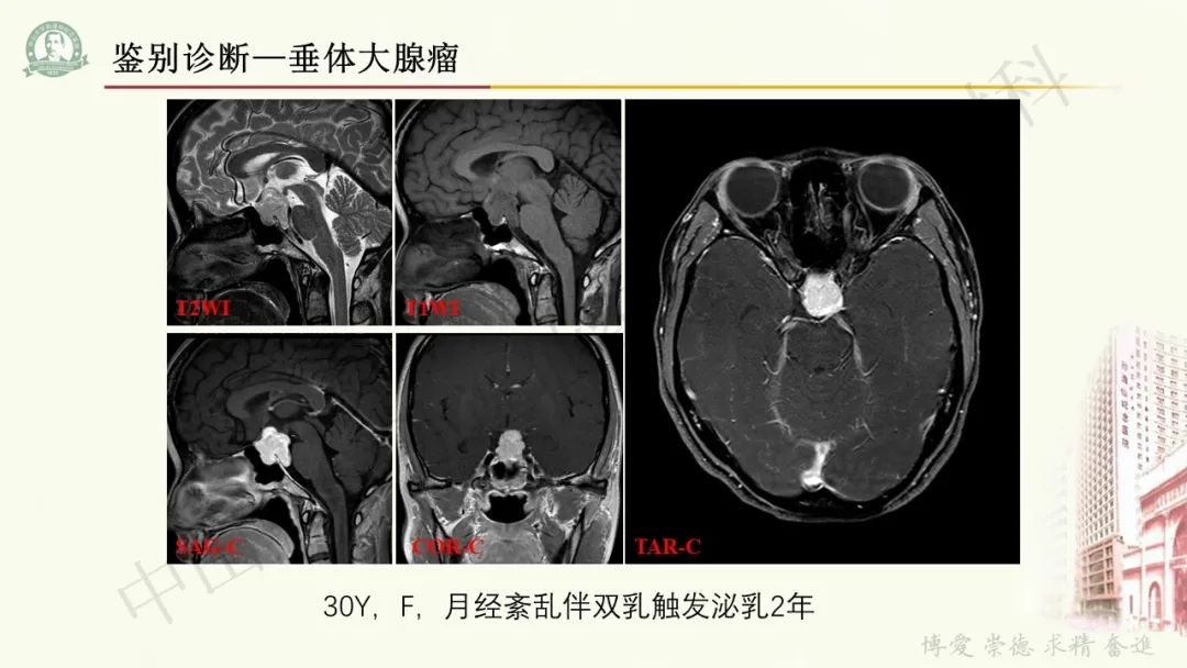 影像PPT - 【病例】毛细胞黏液样星形细胞瘤1例CT及MR影像-30
