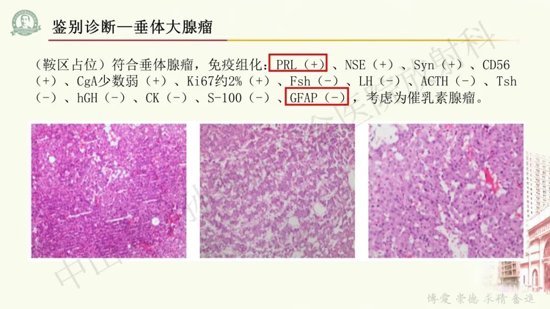 影像PPT - 【病例】毛细胞黏液样星形细胞瘤1例CT及MR影像-31