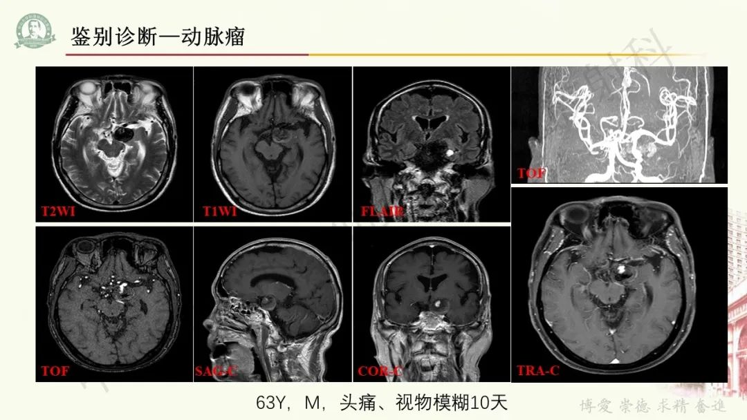 影像PPT - 【病例】毛细胞黏液样星形细胞瘤1例CT及MR影像-33