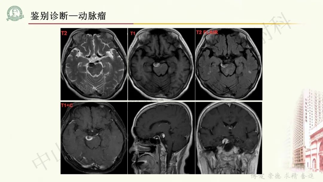 影像PPT - 【病例】毛细胞黏液样星形细胞瘤1例CT及MR影像-34