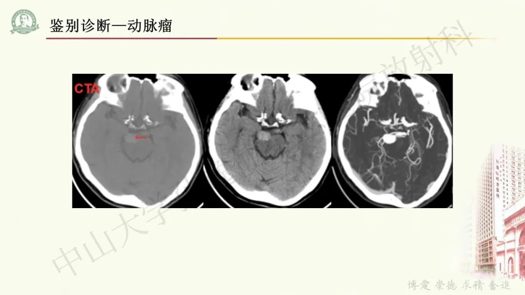 影像PPT - 【病例】毛细胞黏液样星形细胞瘤1例CT及MR影像-35