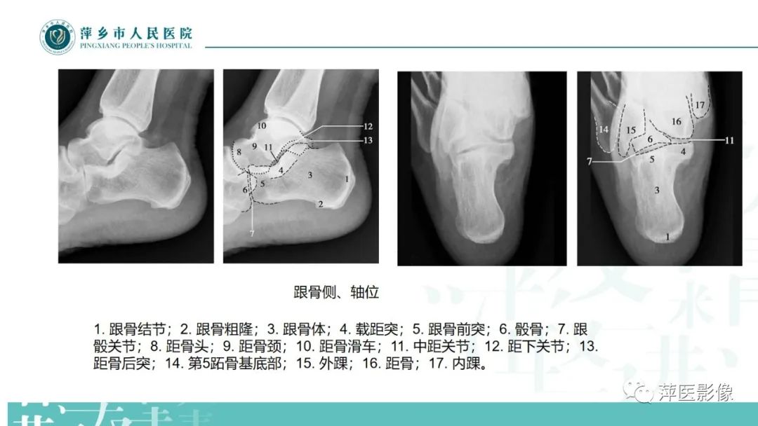 影像PPT - 【PPT】足部X线易混淆结构及相关病变-5