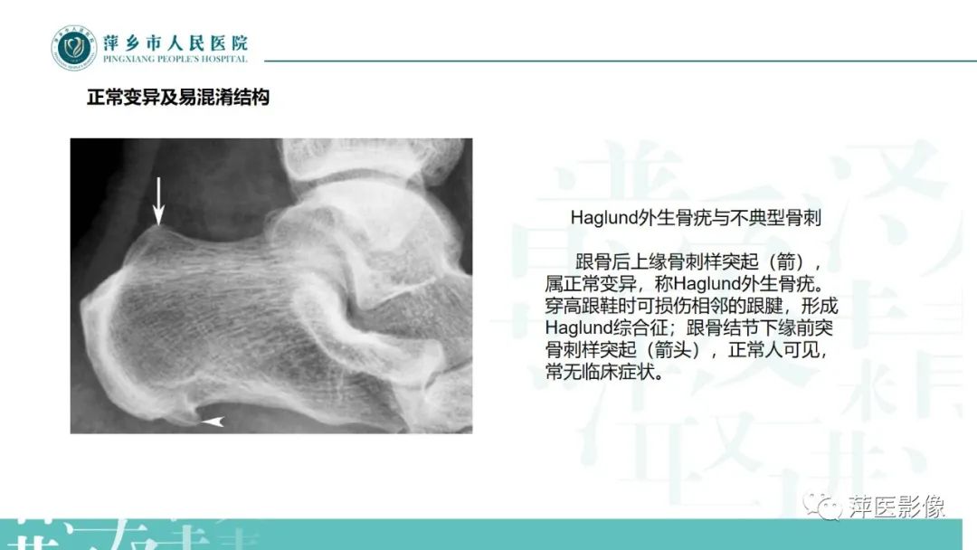 影像PPT - 【PPT】足部X线易混淆结构及相关病变-7