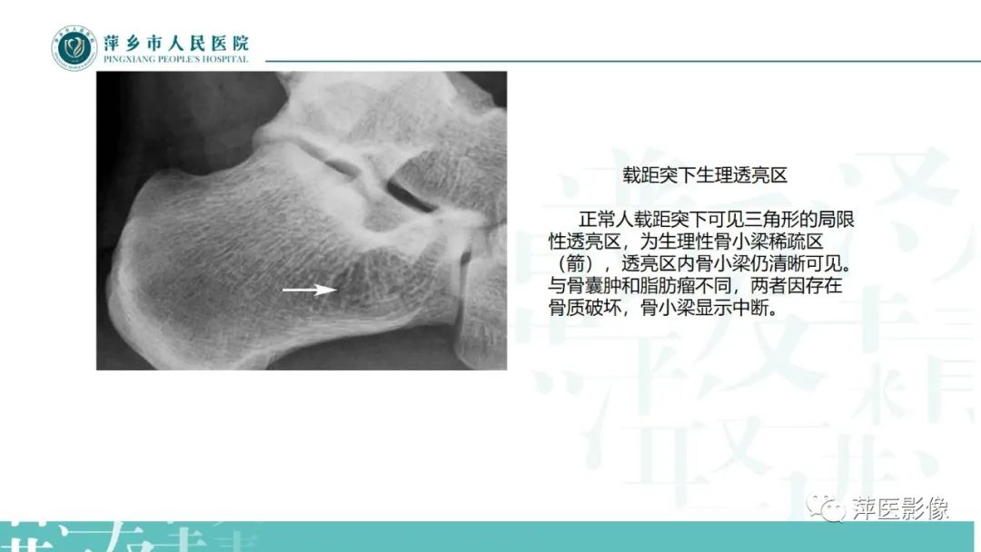 影像PPT - 【PPT】足部X线易混淆结构及相关病变-8