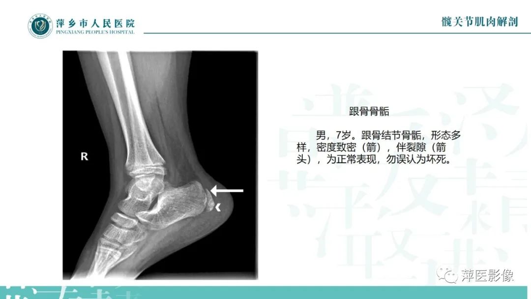 影像PPT - 【PPT】足部X线易混淆结构及相关病变-9