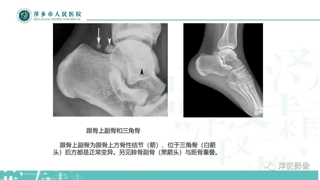 影像PPT - 【PPT】足部X线易混淆结构及相关病变-10