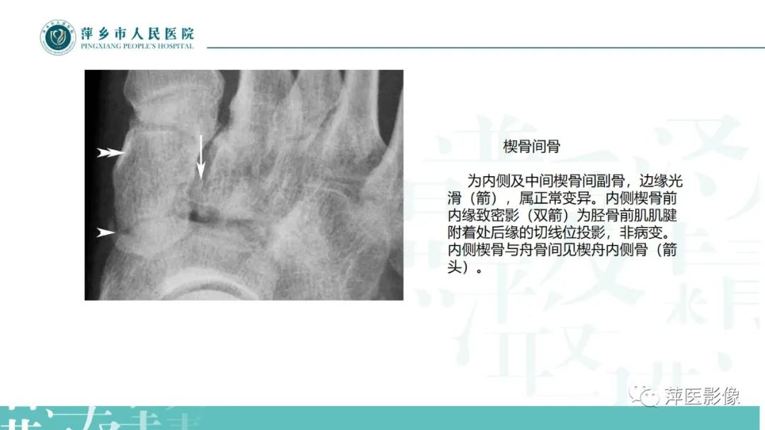 影像PPT - 【PPT】足部X线易混淆结构及相关病变-11