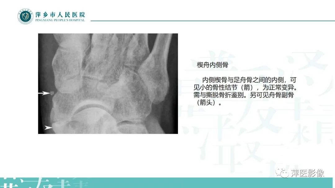影像PPT - 【PPT】足部X线易混淆结构及相关病变-12