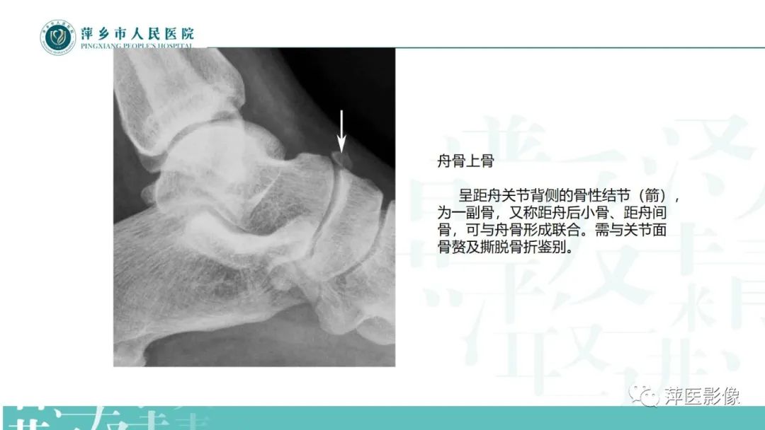 影像PPT - 【PPT】足部X线易混淆结构及相关病变-14