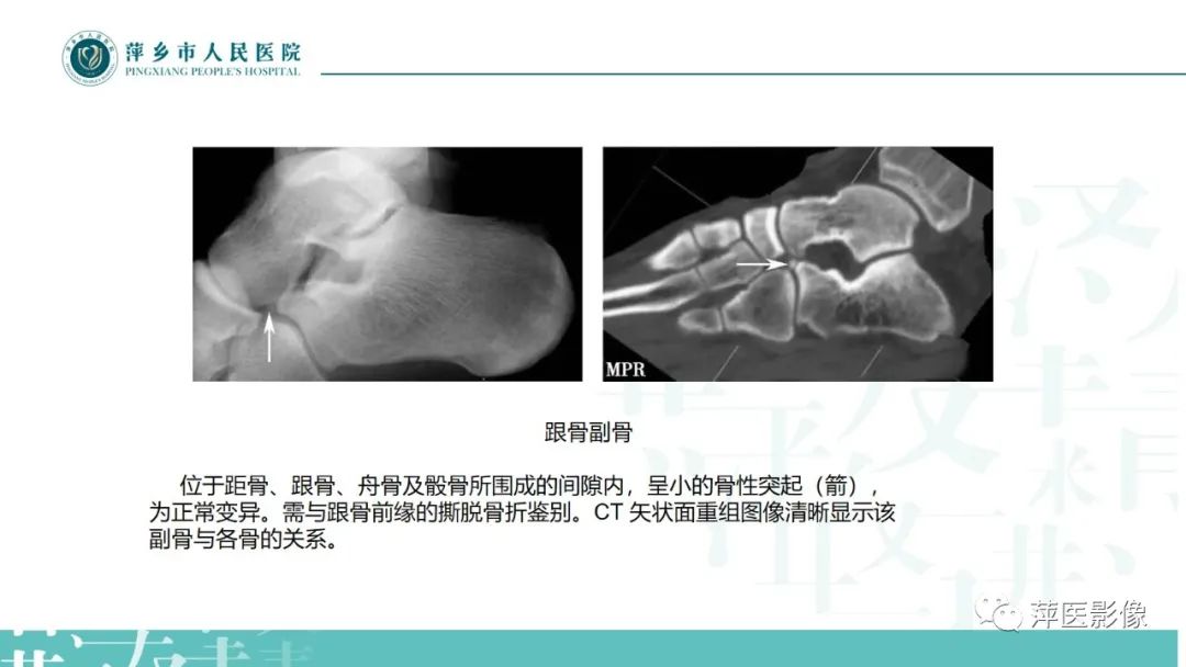 影像PPT - 【PPT】足部X线易混淆结构及相关病变-13