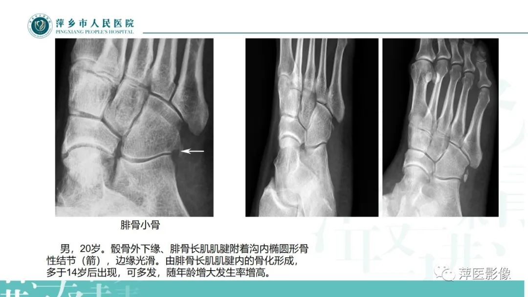 影像PPT - 【PPT】足部X线易混淆结构及相关病变-15