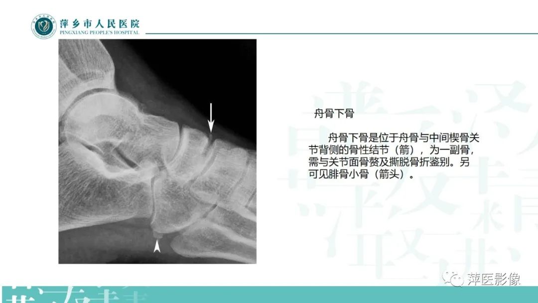 影像PPT - 【PPT】足部X线易混淆结构及相关病变-17