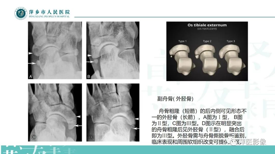 影像PPT - 【PPT】足部X线易混淆结构及相关病变-16