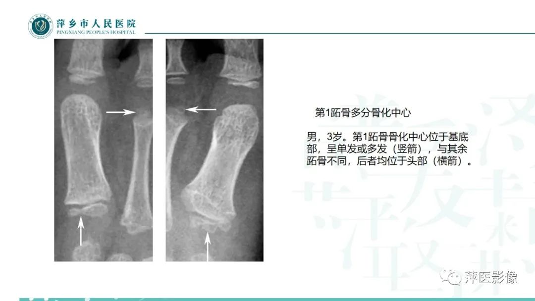 影像PPT - 【PPT】足部X线易混淆结构及相关病变-18