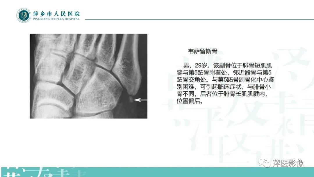 影像PPT - 【PPT】足部X线易混淆结构及相关病变-20