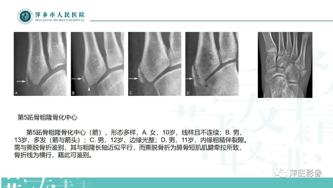 影像PPT - 【PPT】足部X线易混淆结构及相关病变-19