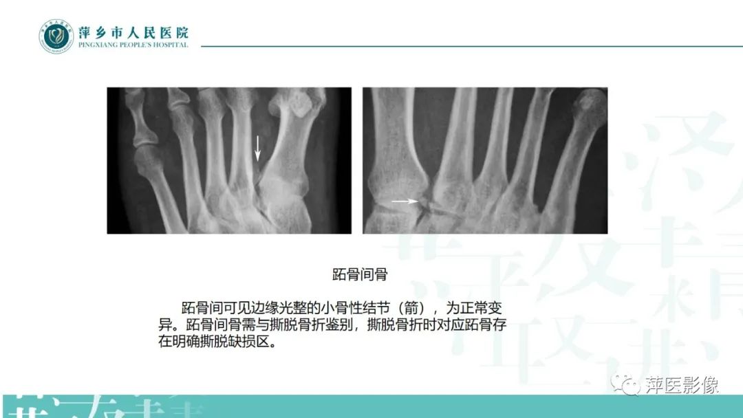 影像PPT - 【PPT】足部X线易混淆结构及相关病变-21