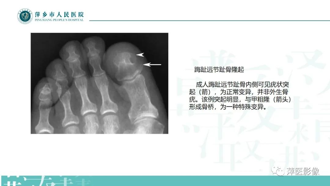 影像PPT - 【PPT】足部X线易混淆结构及相关病变-23