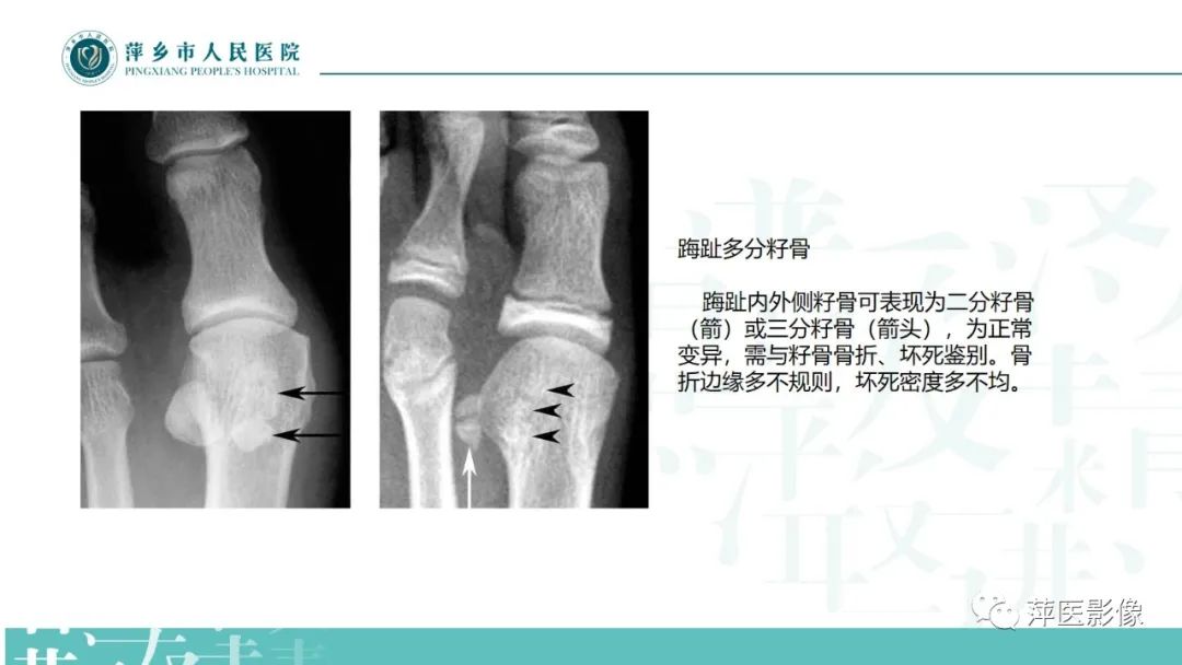 影像PPT - 【PPT】足部X线易混淆结构及相关病变-22