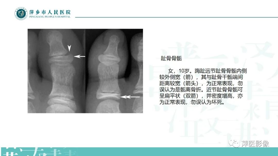 影像PPT - 【PPT】足部X线易混淆结构及相关病变-24
