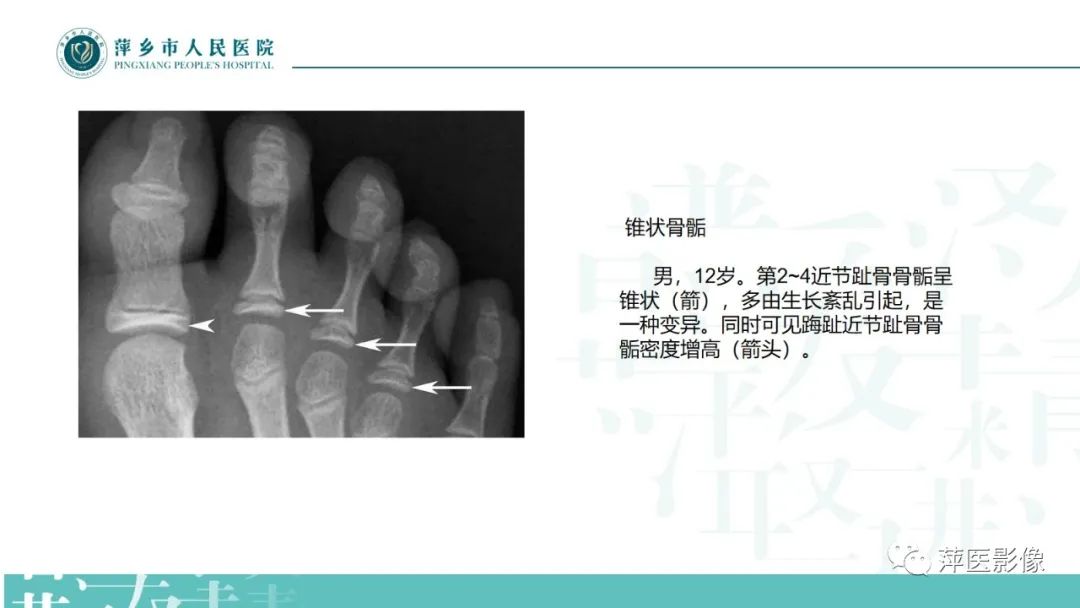 影像PPT - 【PPT】足部X线易混淆结构及相关病变-25