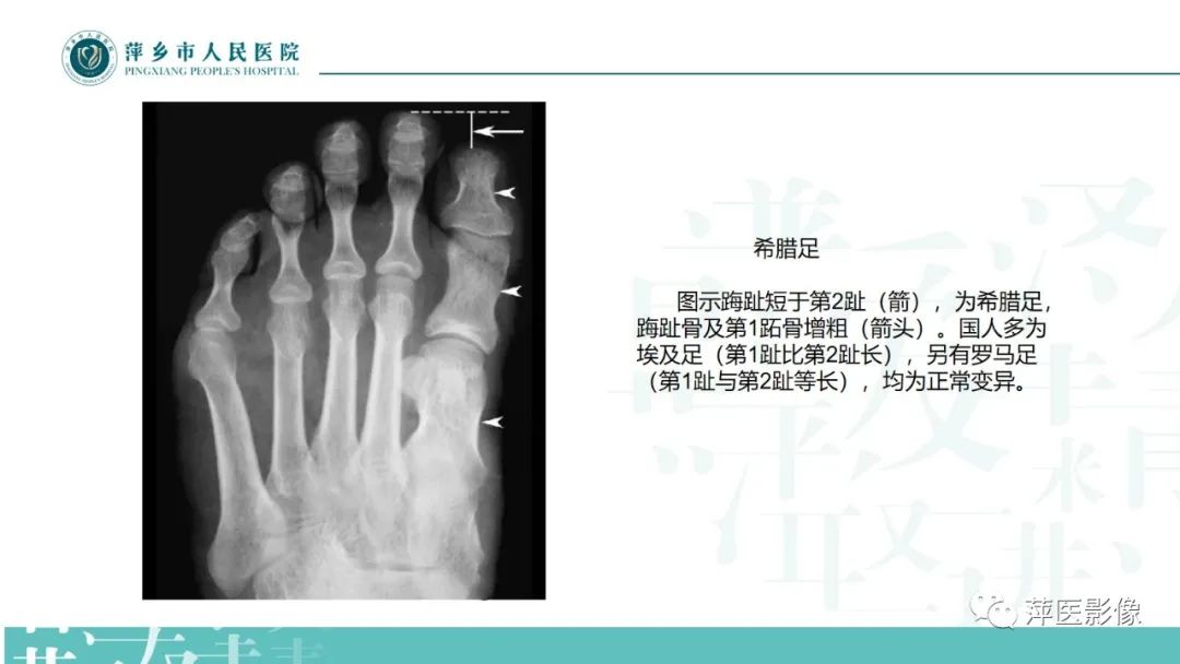 影像PPT - 【PPT】足部X线易混淆结构及相关病变-27