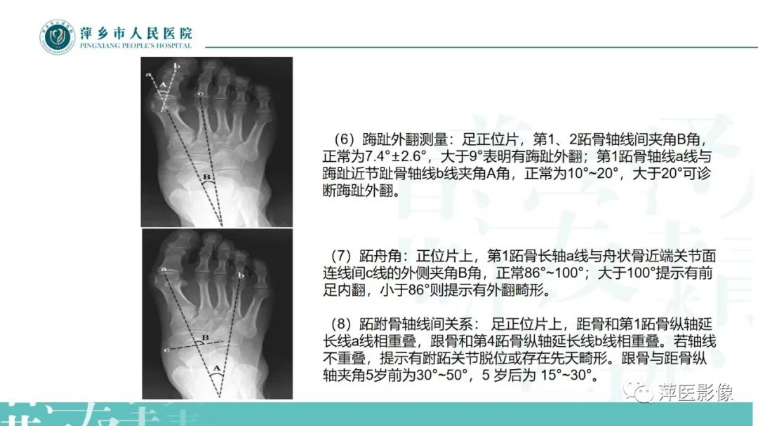 影像PPT - 【PPT】足部X线易混淆结构及相关病变-29