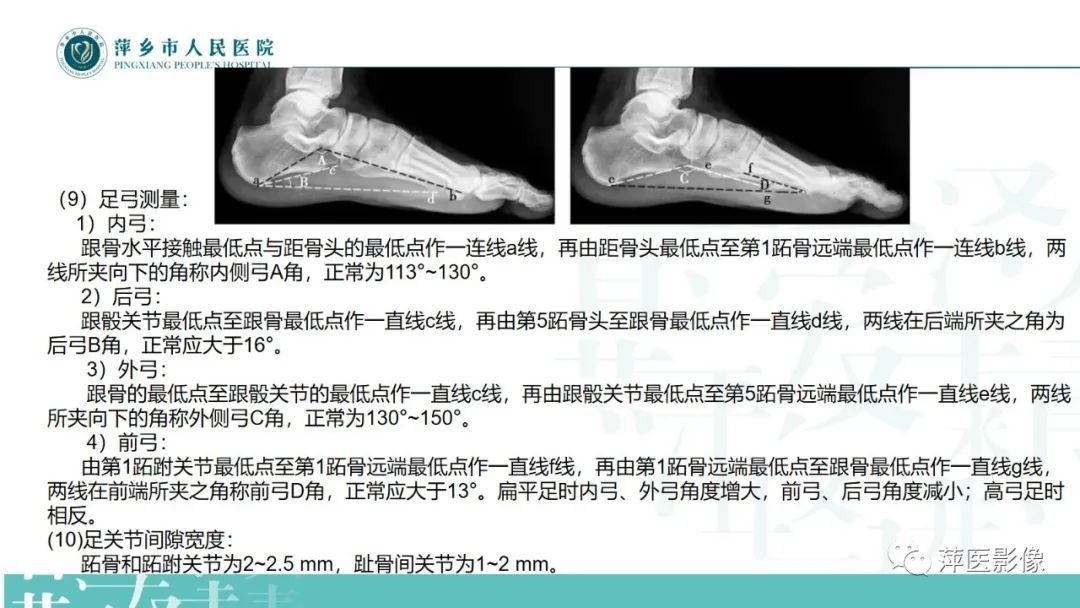 影像PPT - 【PPT】足部X线易混淆结构及相关病变-30