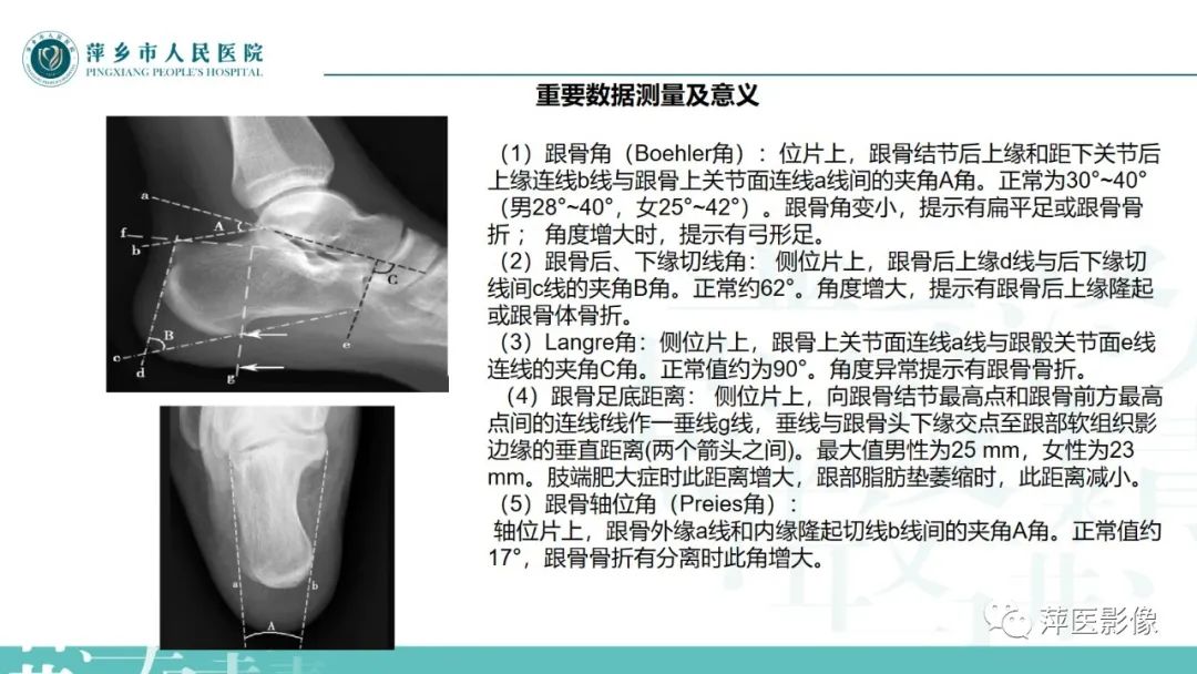 影像PPT - 【PPT】足部X线易混淆结构及相关病变-28
