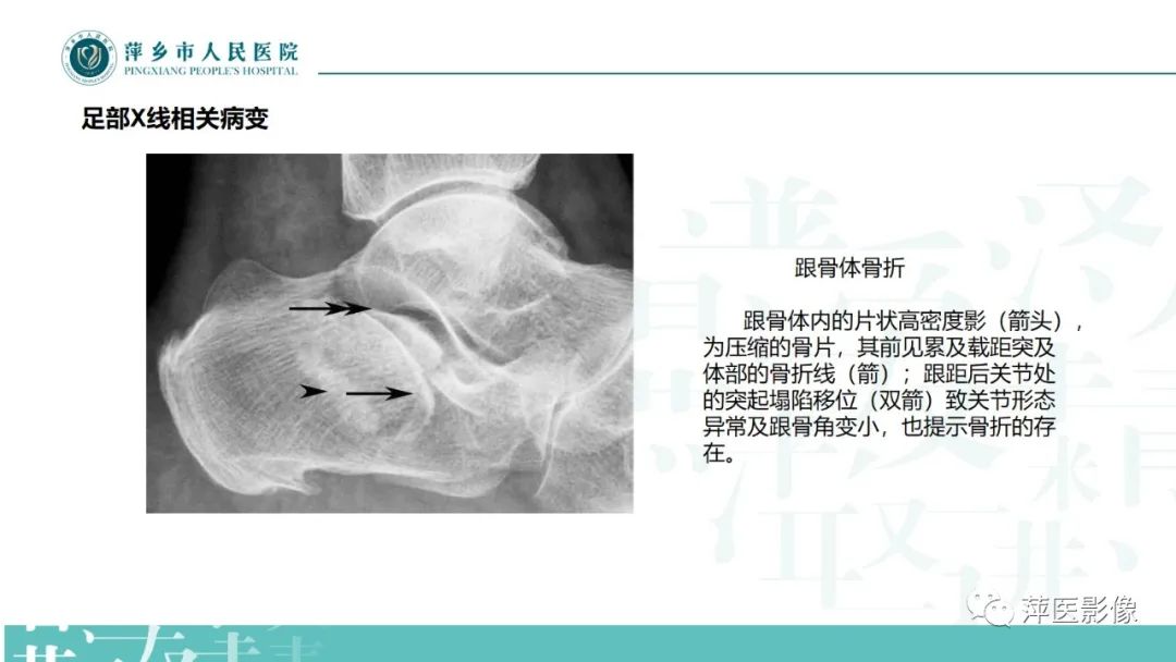 影像PPT - 【PPT】足部X线易混淆结构及相关病变-32