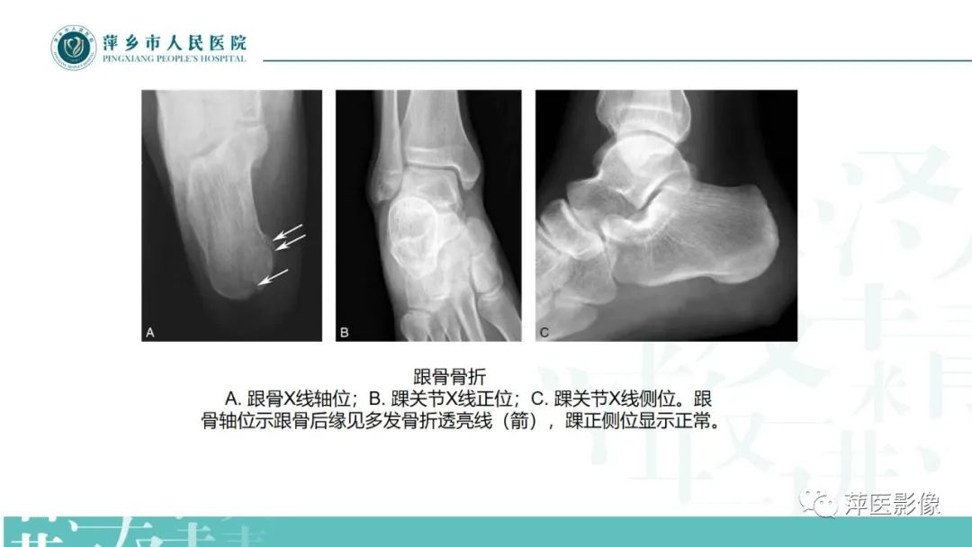 影像PPT - 【PPT】足部X线易混淆结构及相关病变-34