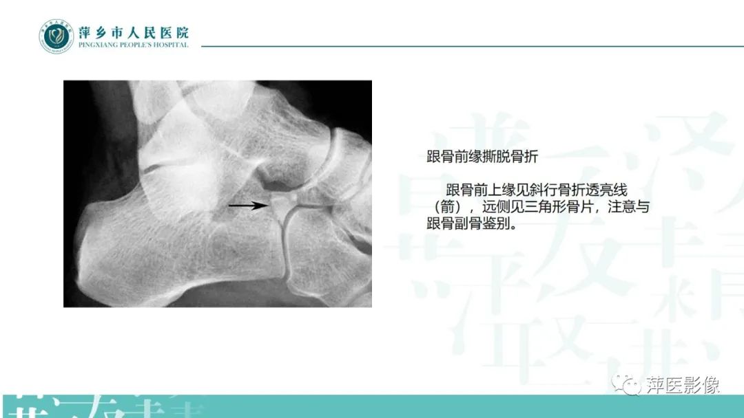 影像PPT - 【PPT】足部X线易混淆结构及相关病变-33