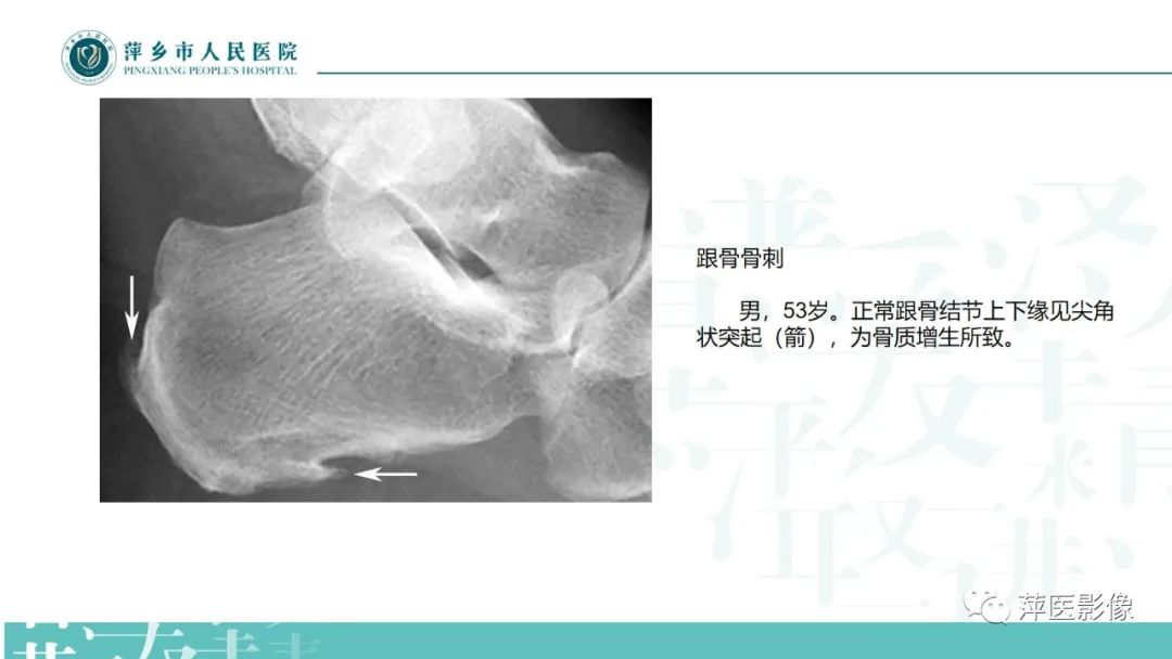 影像PPT - 【PPT】足部X线易混淆结构及相关病变-35
