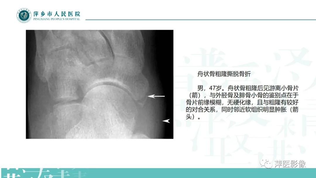 影像PPT - 【PPT】足部X线易混淆结构及相关病变-36