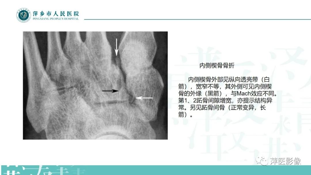 影像PPT - 【PPT】足部X线易混淆结构及相关病变-37