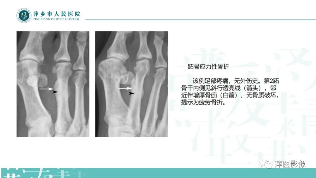 影像PPT - 【PPT】足部X线易混淆结构及相关病变-38