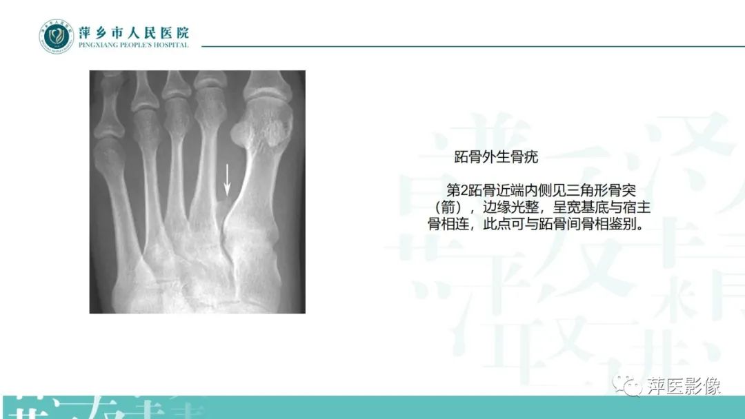 影像PPT - 【PPT】足部X线易混淆结构及相关病变-40