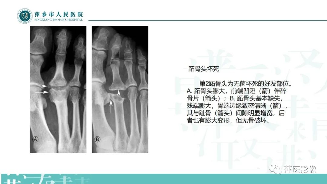 影像PPT - 【PPT】足部X线易混淆结构及相关病变-39