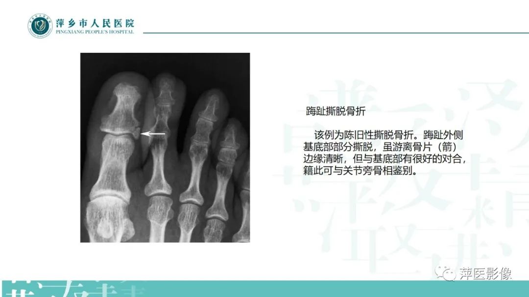 影像PPT - 【PPT】足部X线易混淆结构及相关病变-42