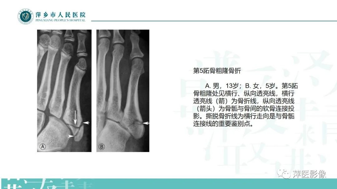影像PPT - 【PPT】足部X线易混淆结构及相关病变-41