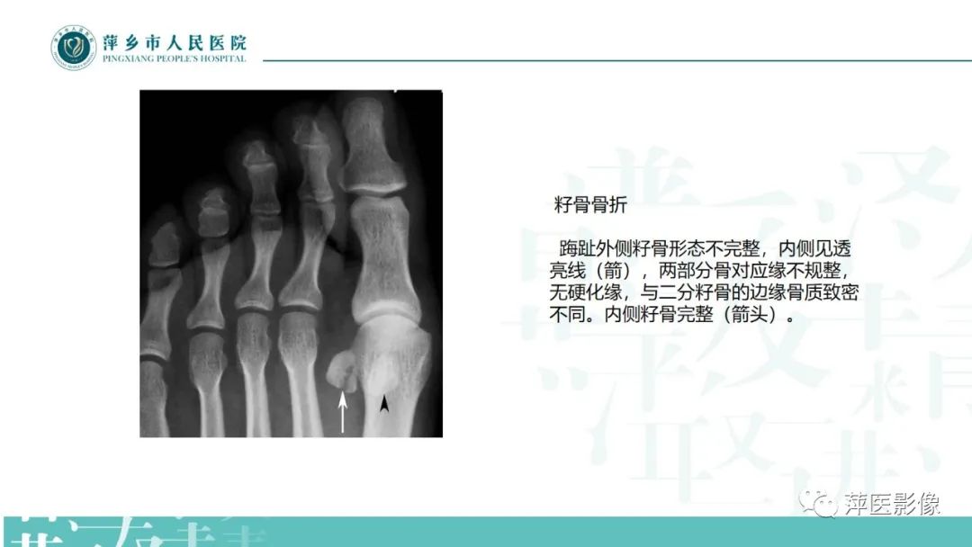 影像PPT - 【PPT】足部X线易混淆结构及相关病变-43