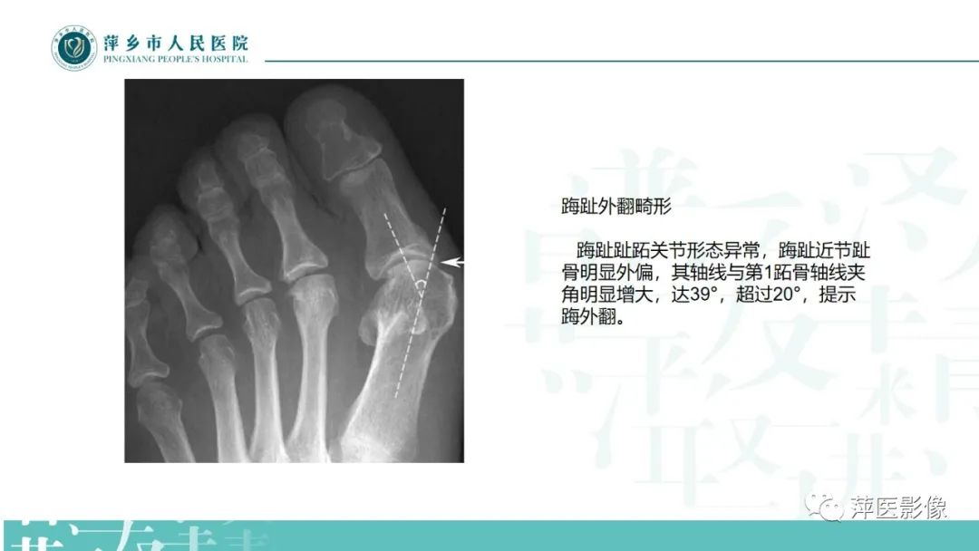 影像PPT - 【PPT】足部X线易混淆结构及相关病变-44