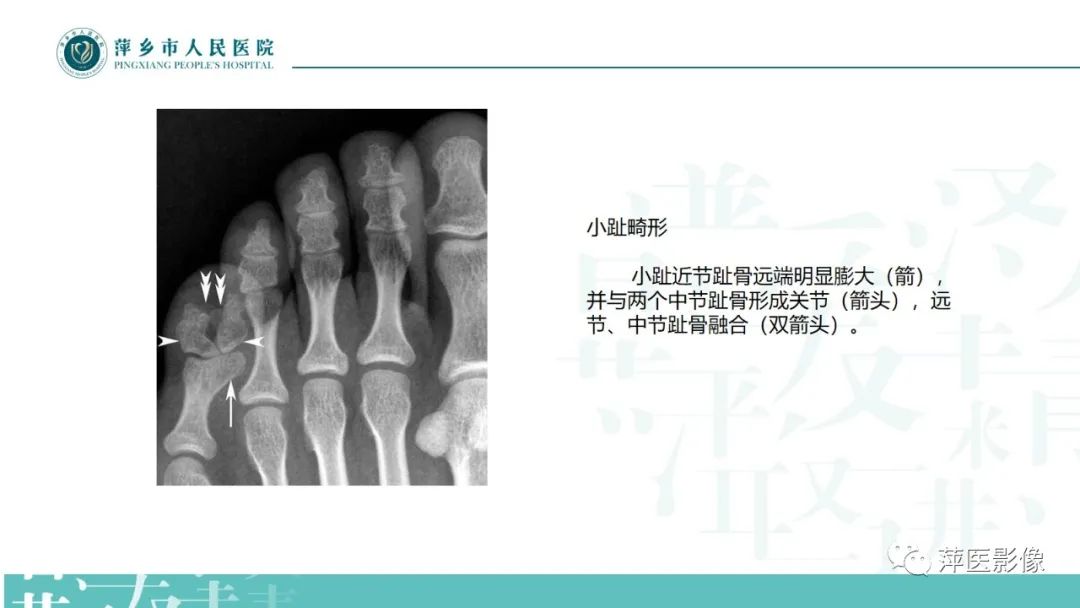 影像PPT - 【PPT】足部X线易混淆结构及相关病变-45