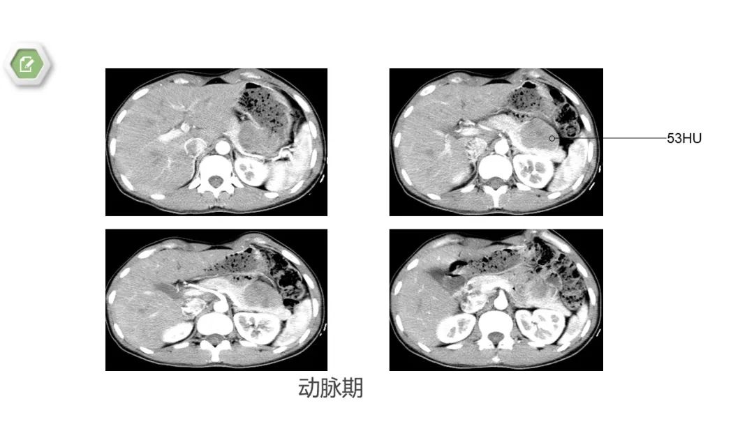 影像PPT - 【病例】胰腺实性假乳头状瘤1例CT影像-5
