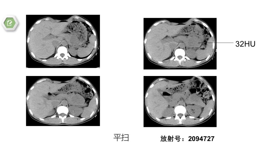 影像PPT - 【病例】胰腺实性假乳头状瘤1例CT影像-4