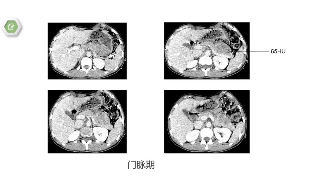 影像PPT - 【病例】胰腺实性假乳头状瘤1例CT影像-6
