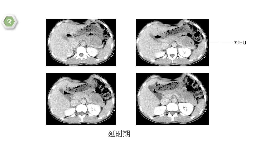影像PPT - 【病例】胰腺实性假乳头状瘤1例CT影像-7