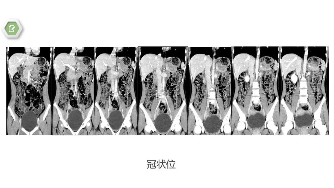 影像PPT - 【病例】胰腺实性假乳头状瘤1例CT影像-8