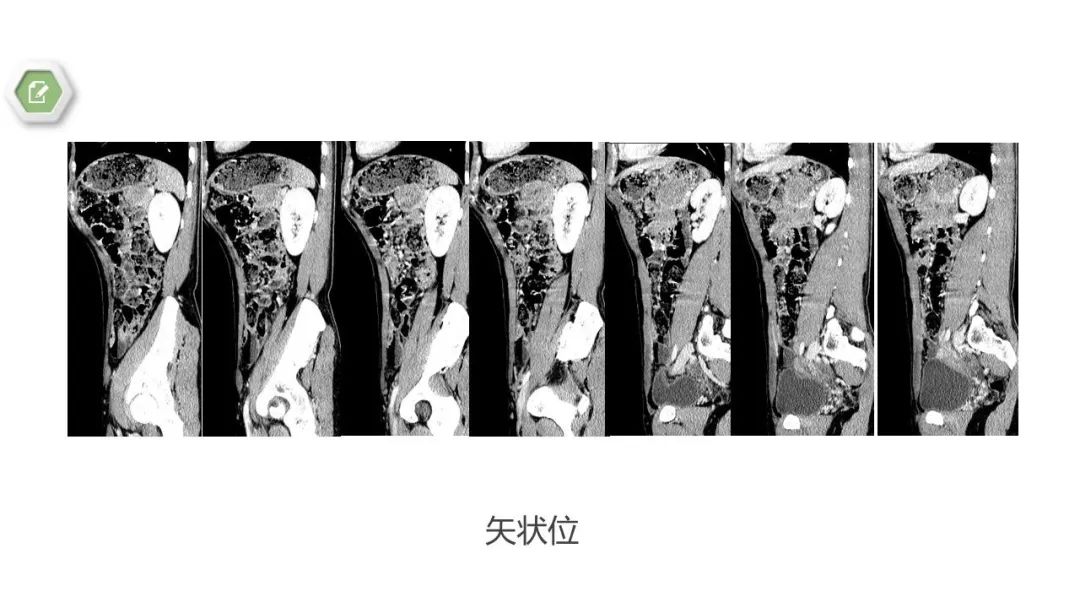 影像PPT - 【病例】胰腺实性假乳头状瘤1例CT影像-9